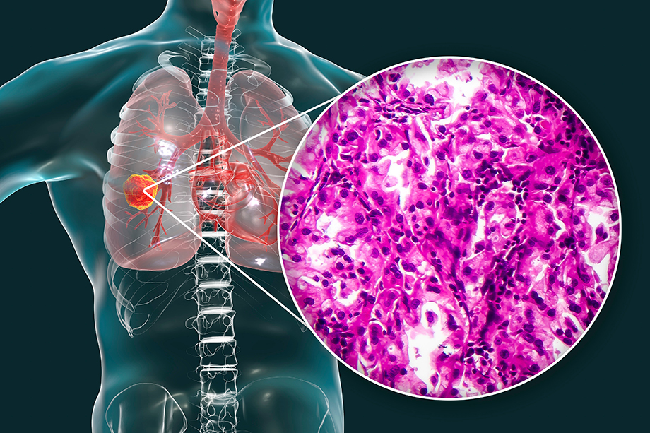 Non-small cell lung adenocarcinoma occurs in the glandular tissue of the lung and is illustrated here with a histopathology light micrograph. | Adobe Stock